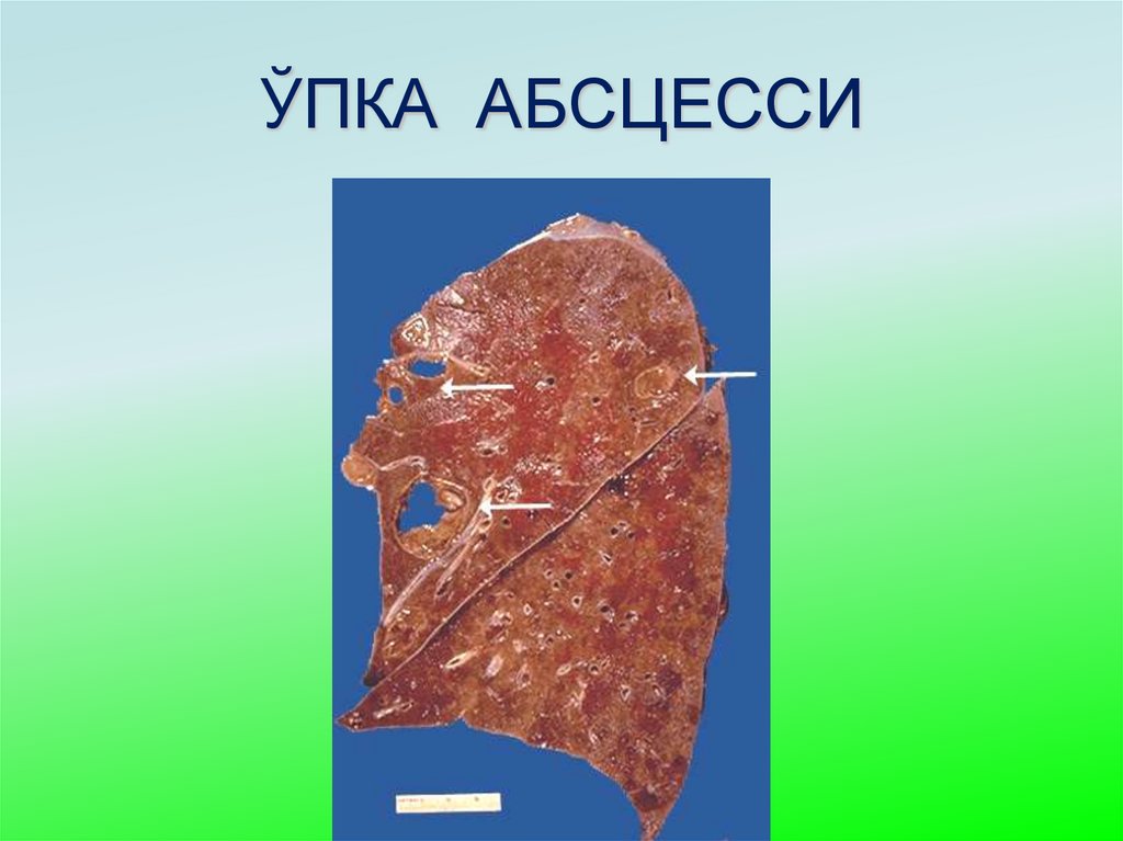 ЎПКА АБСЦЕССИ