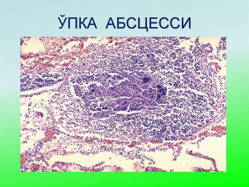 ЎПКА АБСЦЕССИ