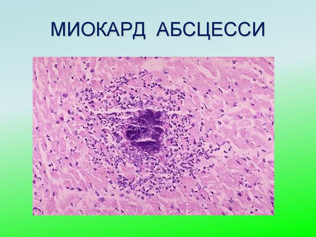 МИОКАРД АБСЦЕССИ