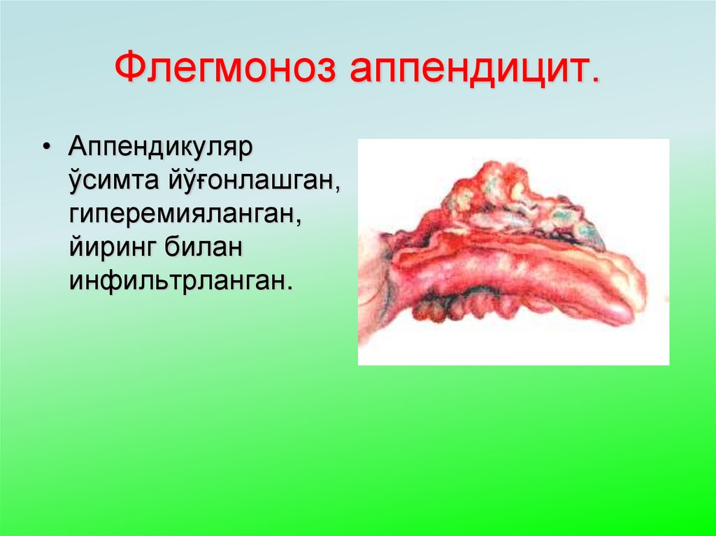 Флегмоноз аппендицит.