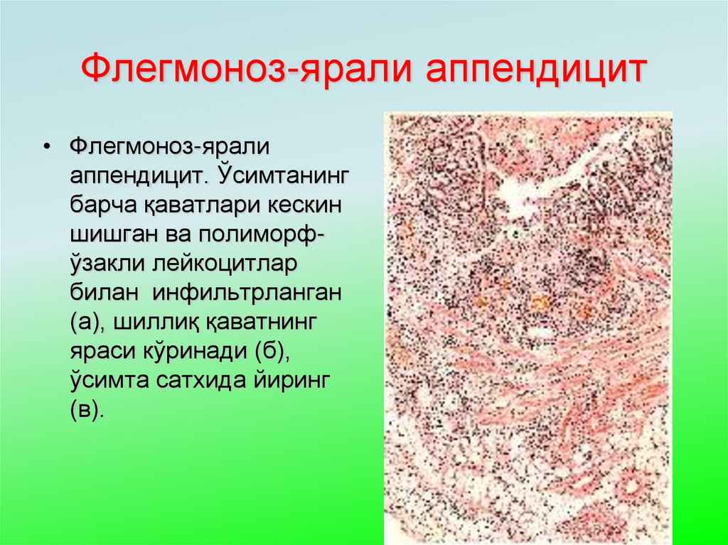 Флегмоноз-ярали аппендицит