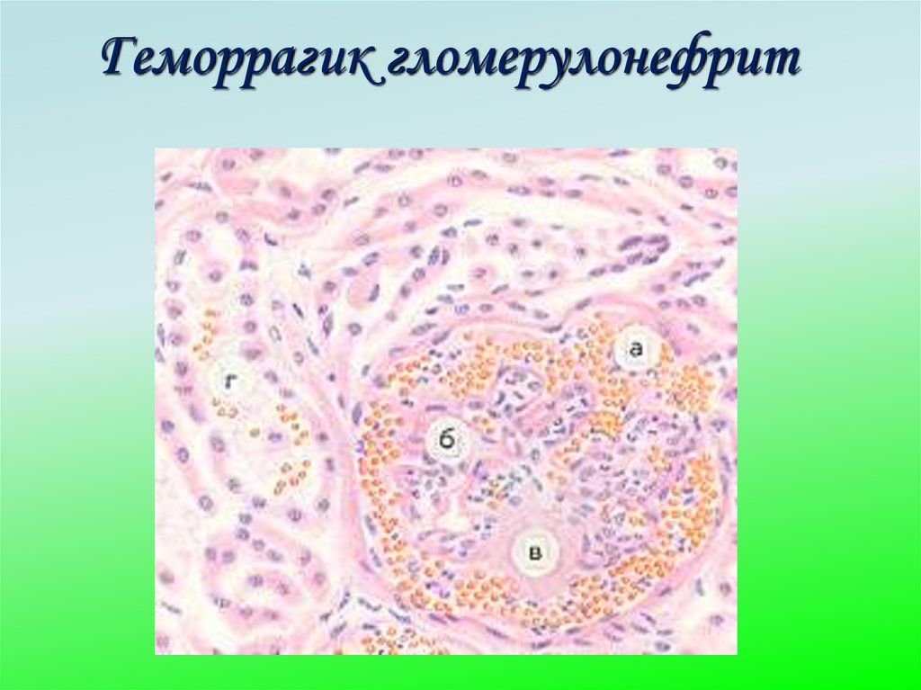 Геморрагик гломерулонефрит