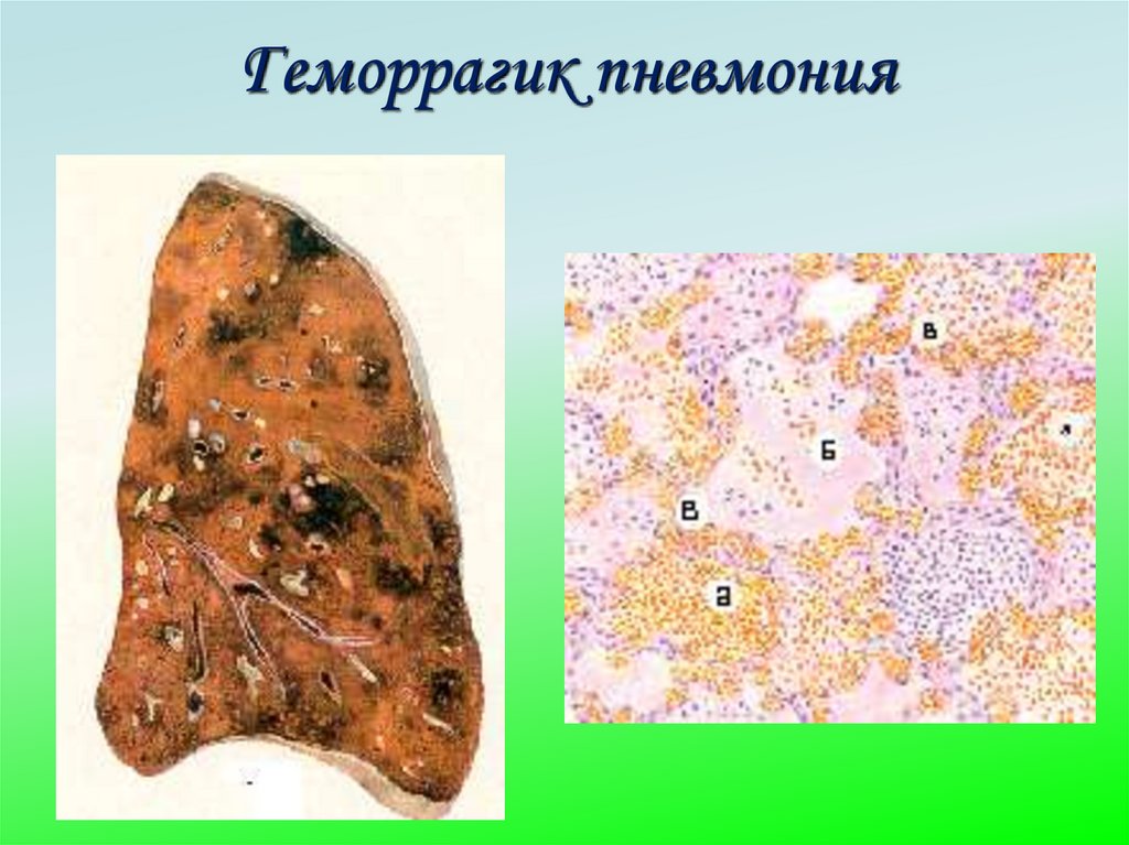 Геморрагик пневмония