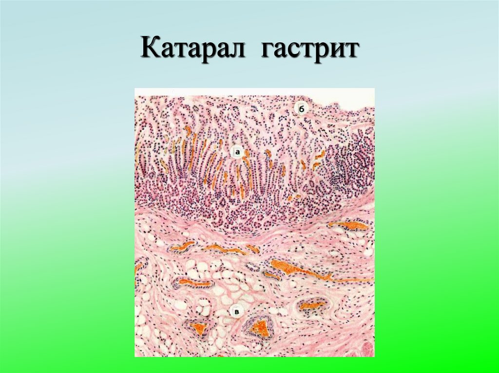 Катарал гастрит