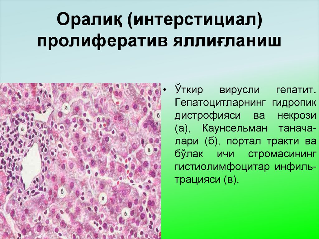 Оралиқ (интерстициал) пролифератив яллиғланиш