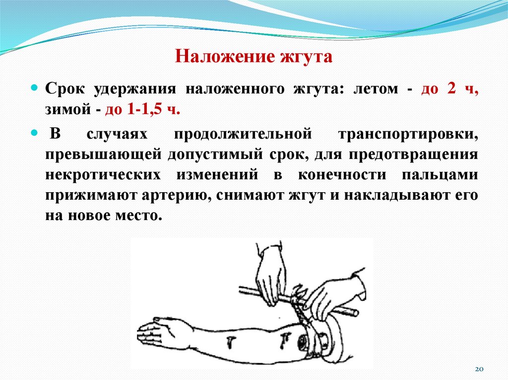 Наложение жгута