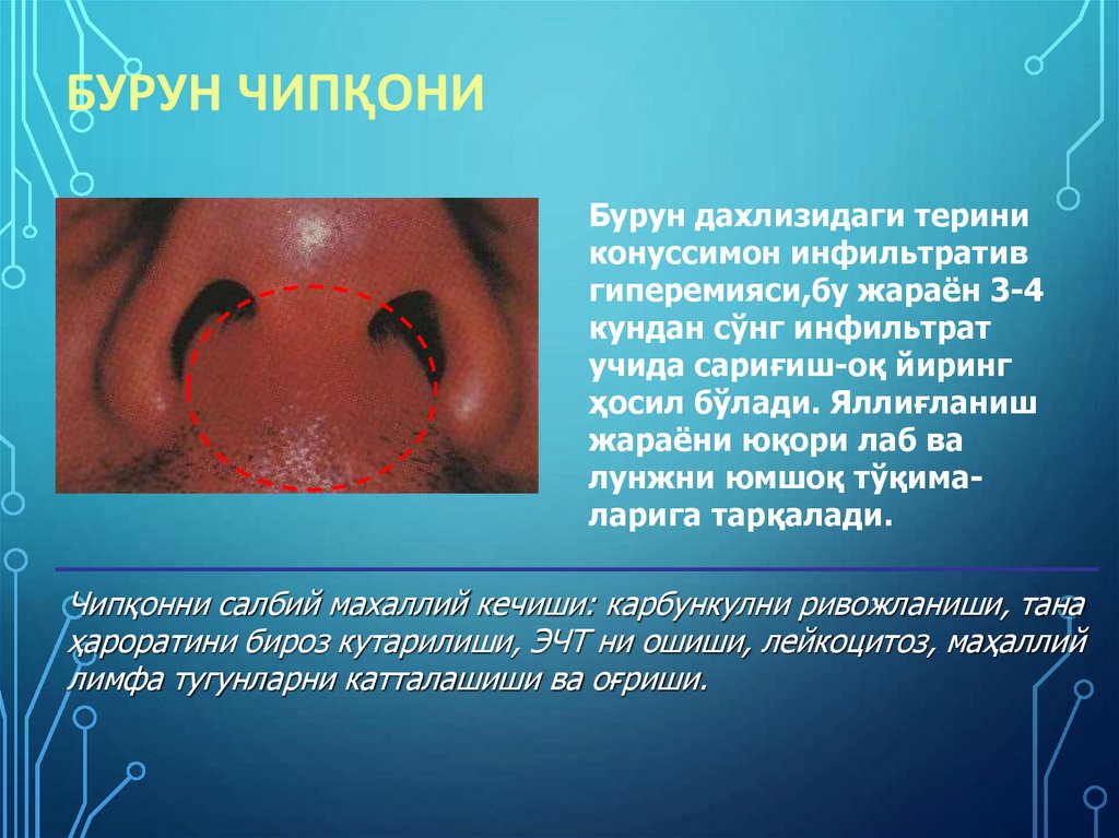 Бурун чипқони