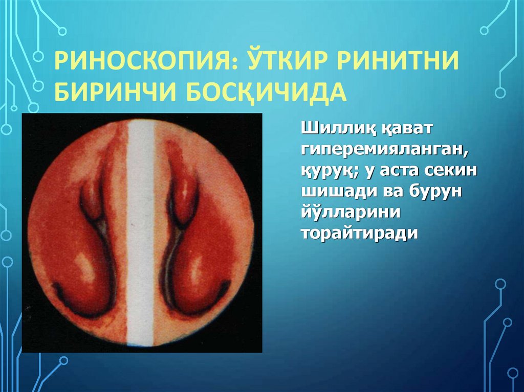 Риноскопия: ўткир ринитни биринчи босқичида