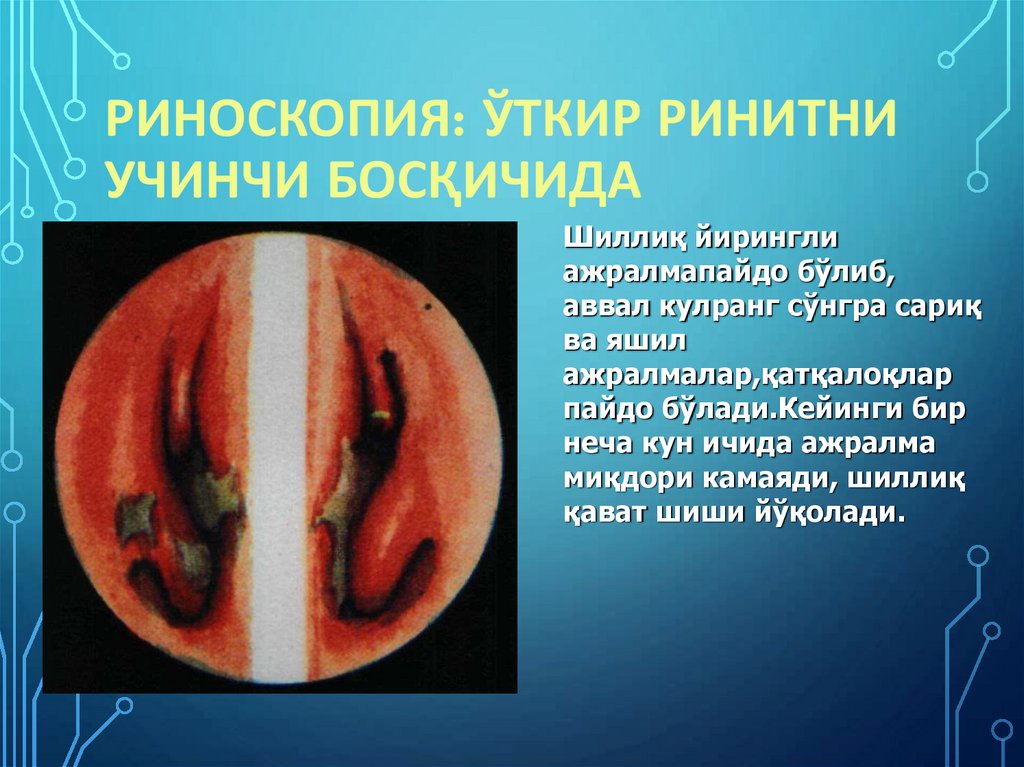Риноскопия: ўткир ринитни учинчи босқичида
