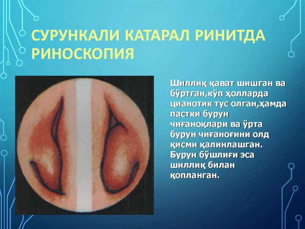 Сурункали катарал ринитда риноскопия