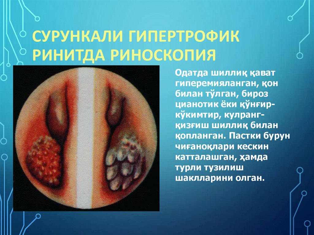 Сурункали гипертрофик ринитда риноскопия