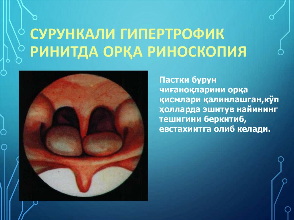 Сурункали гипертрофик ринитда орқа риноскопия