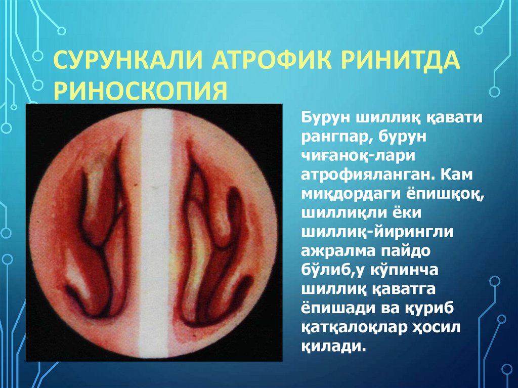 Сурункали атрофик ринитда риноскопия