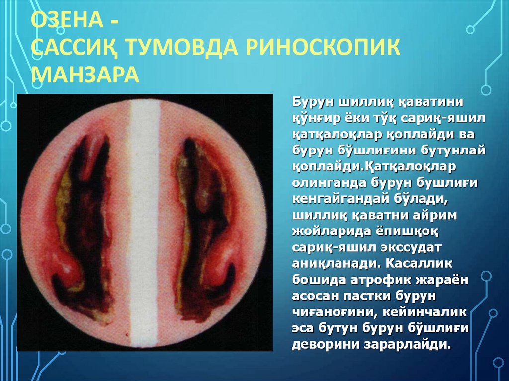 ОЗЕНА - Сассиқ тумовда риноскопик манзара
