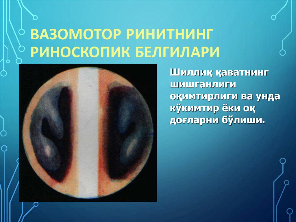 Вазомотор ринитнинг риноскопик белгилари