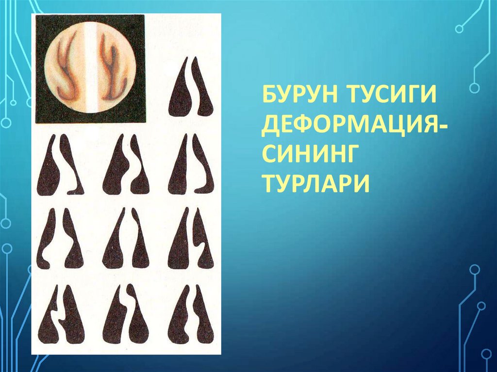 Бурун тусиги деформация- сининг турлари