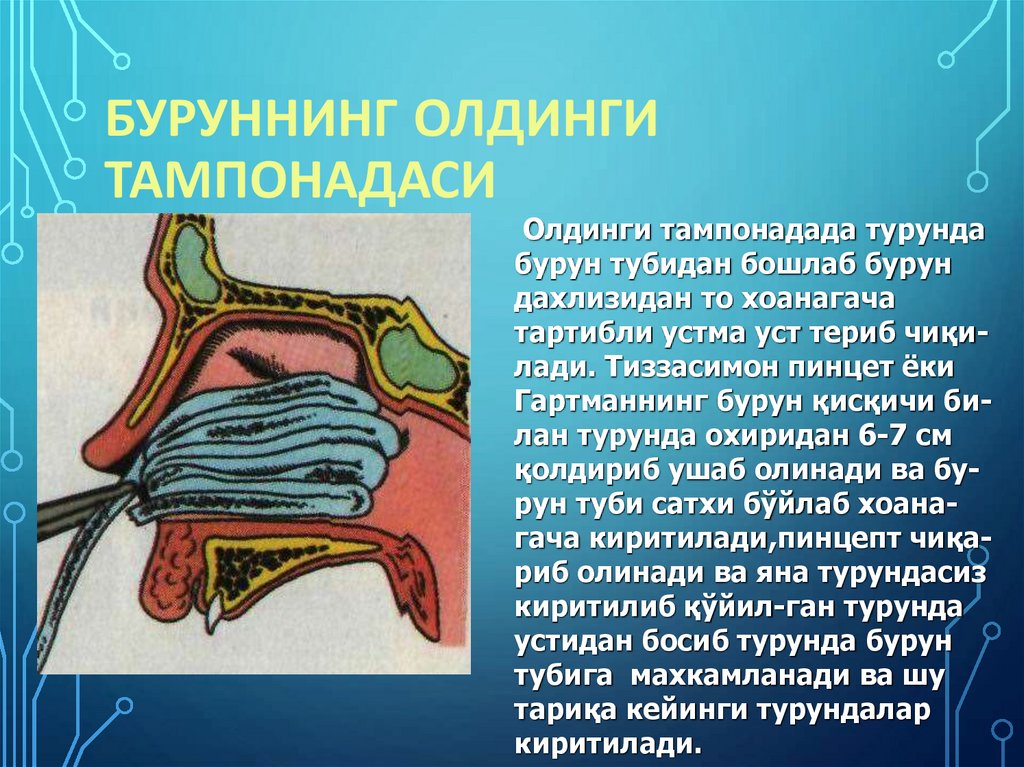 Буруннинг олдинги тампонадаси