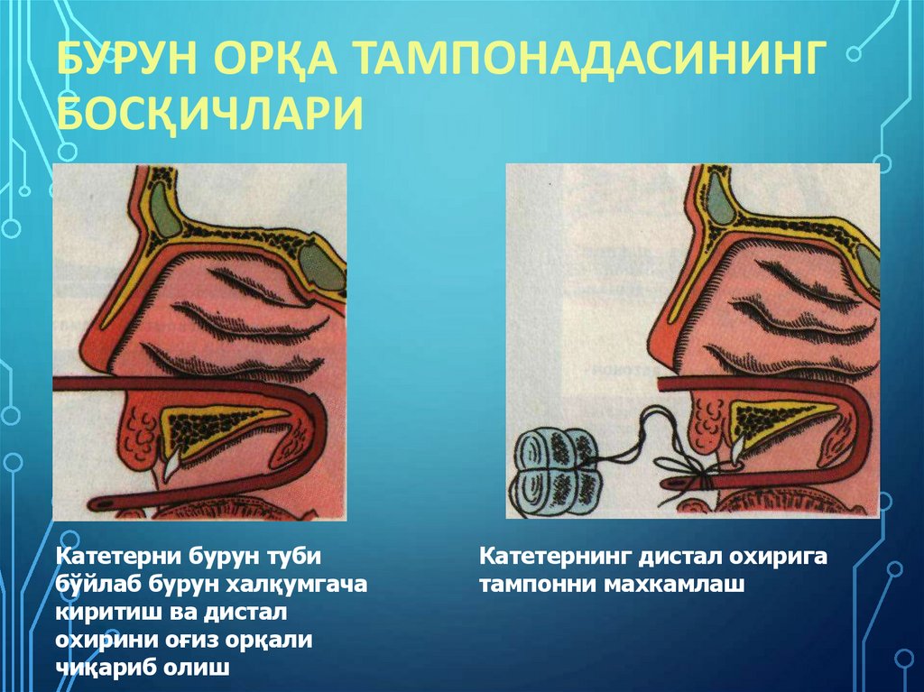 Бурун орқа тампонадасининг босқичлари