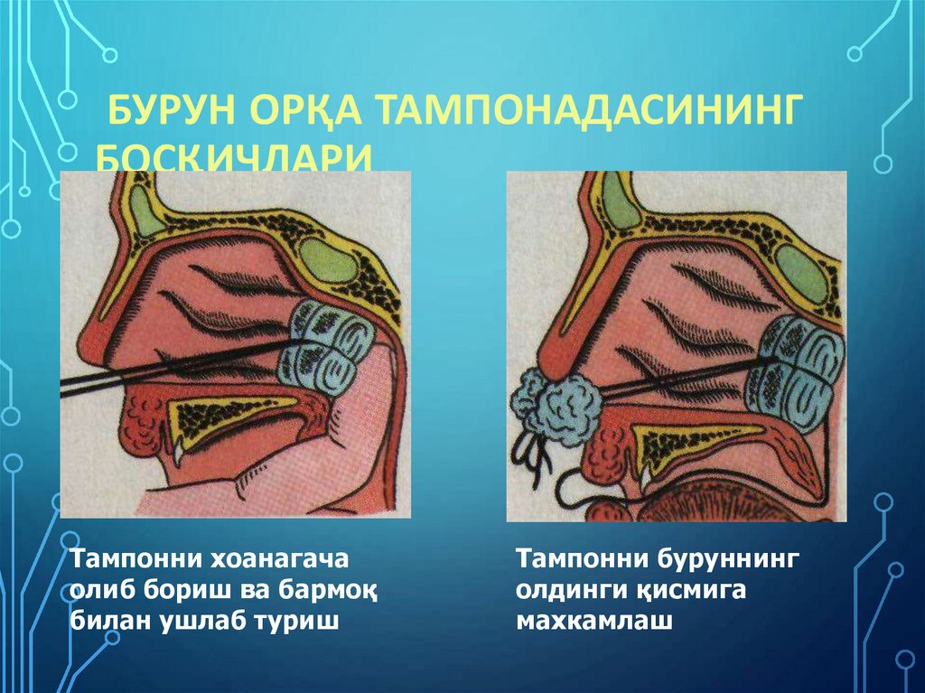 Бурун орқа тампонадасининг босқичлари