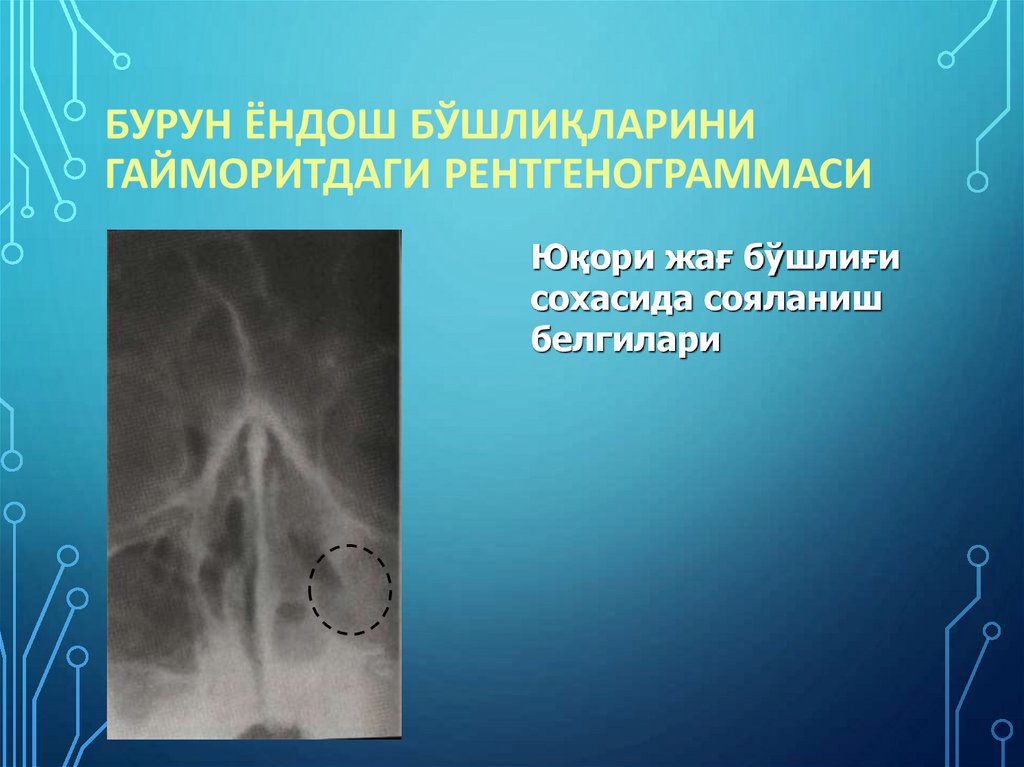 Бурун ёндош бўшлиқларини гайморитдаги рентгенограммаси