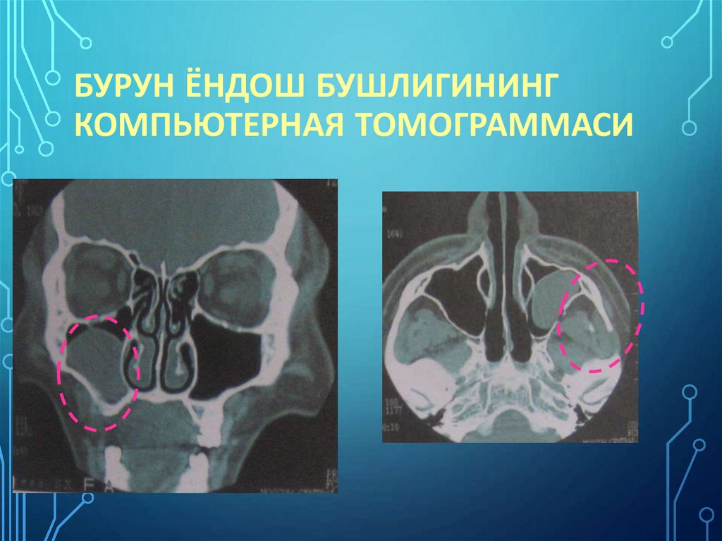 Бурун ёндош бушлигининг компьютерная томограммаси