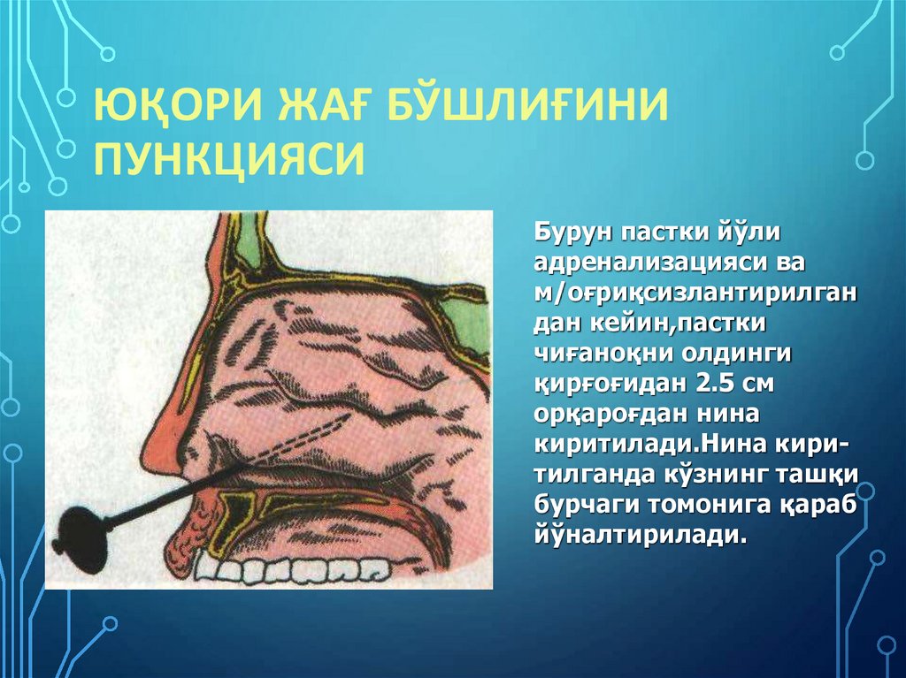 Юқори жағ бўшлиғини пункцияси