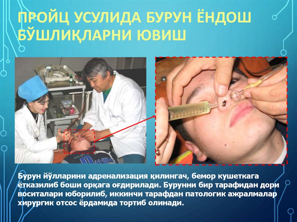 Пройц усулида бурун ёндош бўшлиқларни ювиш