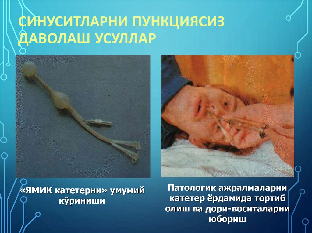 Синуситларни пункциясиз даволаш усуллар