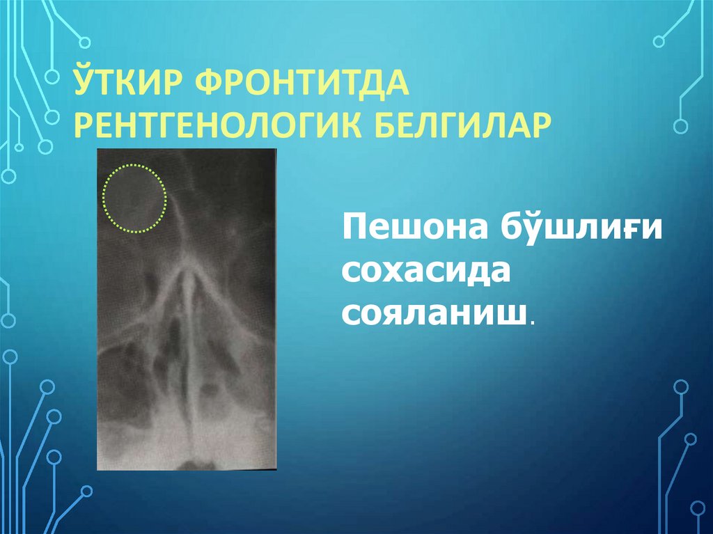 Ўткир фронтитда рентгенологик белгилар