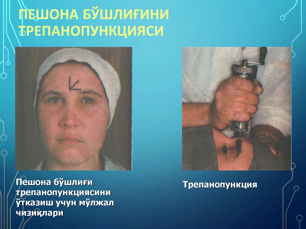 Пешона бўшлиғини трепанопункцияси