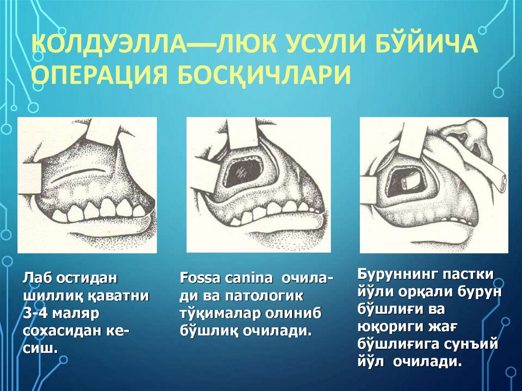Колдуэлла—Люк усули бўйича операция босқичлари