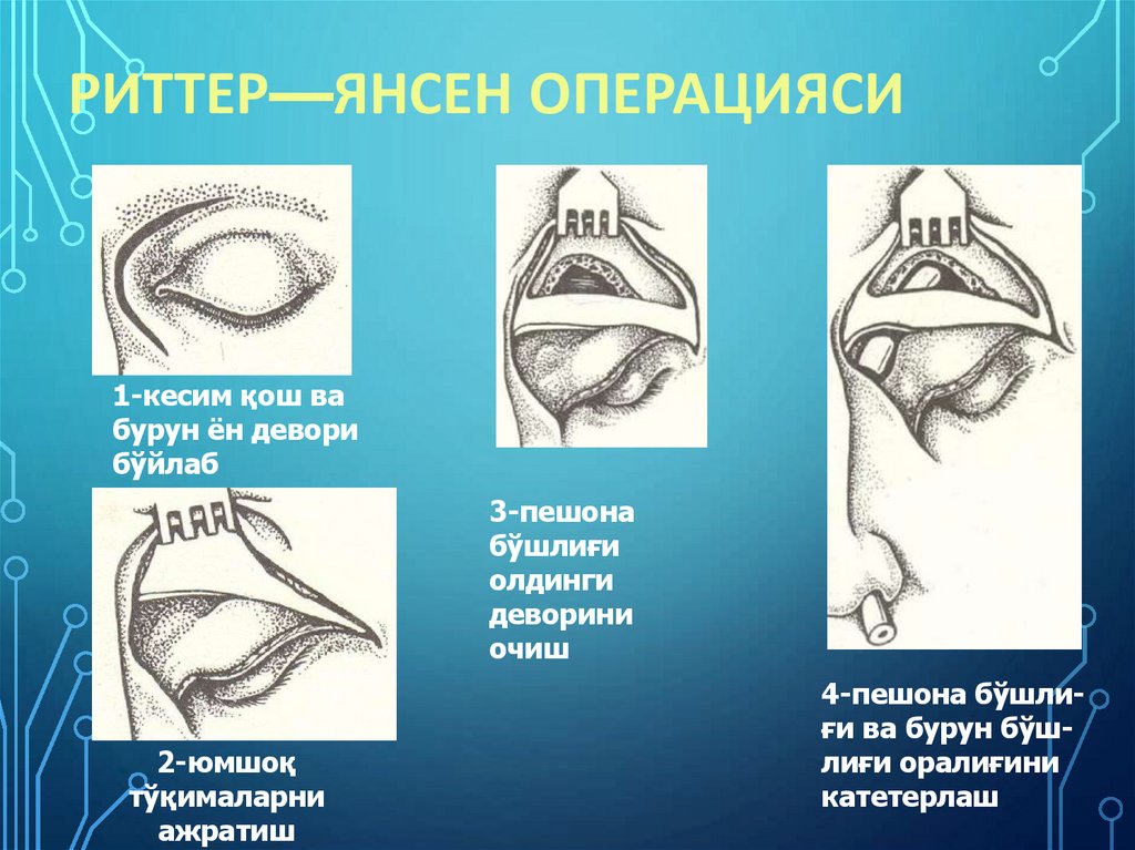 Риттер—Янсен операцияси