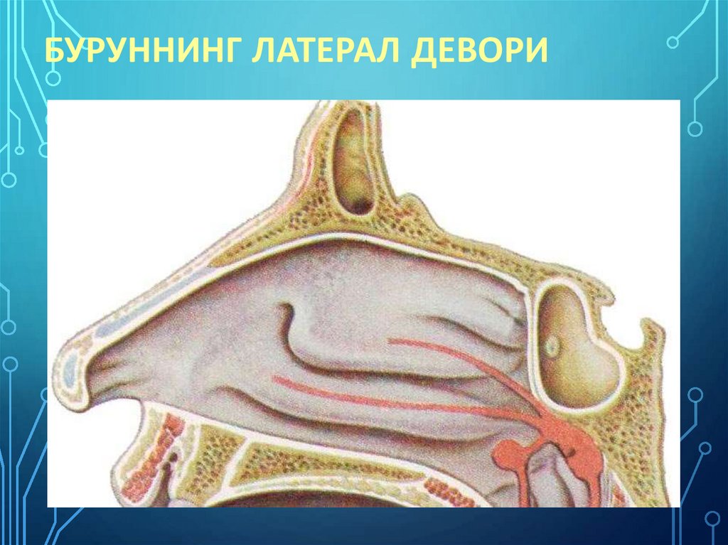 Буруннинг латерал девори