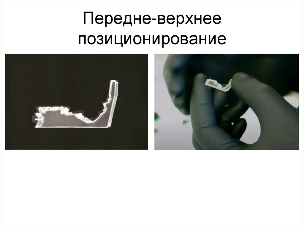 Передне-верхнее позиционирование