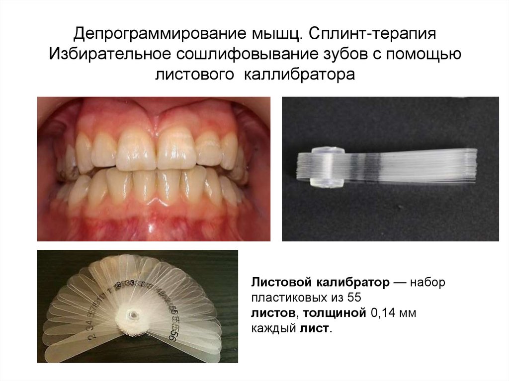 Депрограммирование мышц. Сплинт-терапия Избирательное сошлифовывание зубов с помощью листового каллибратора