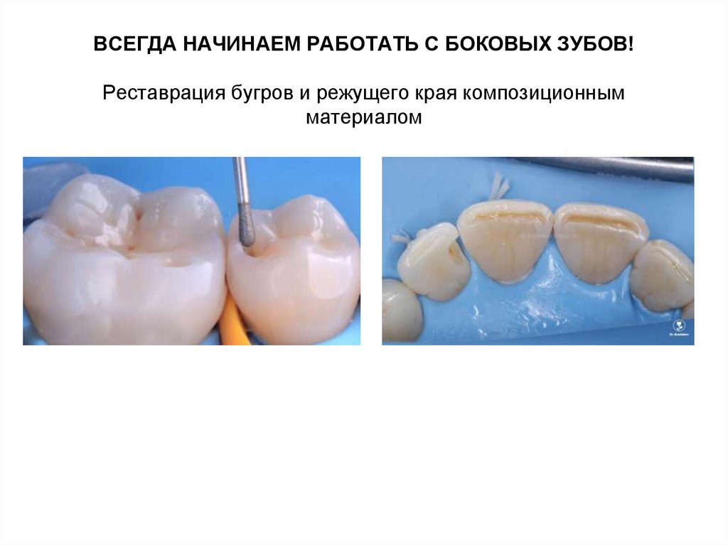 ВСЕГДА НАЧИНАЕМ РАБОТАТЬ С БОКОВЫХ ЗУБОВ! Реставрация бугров и режущего края композиционным материалом