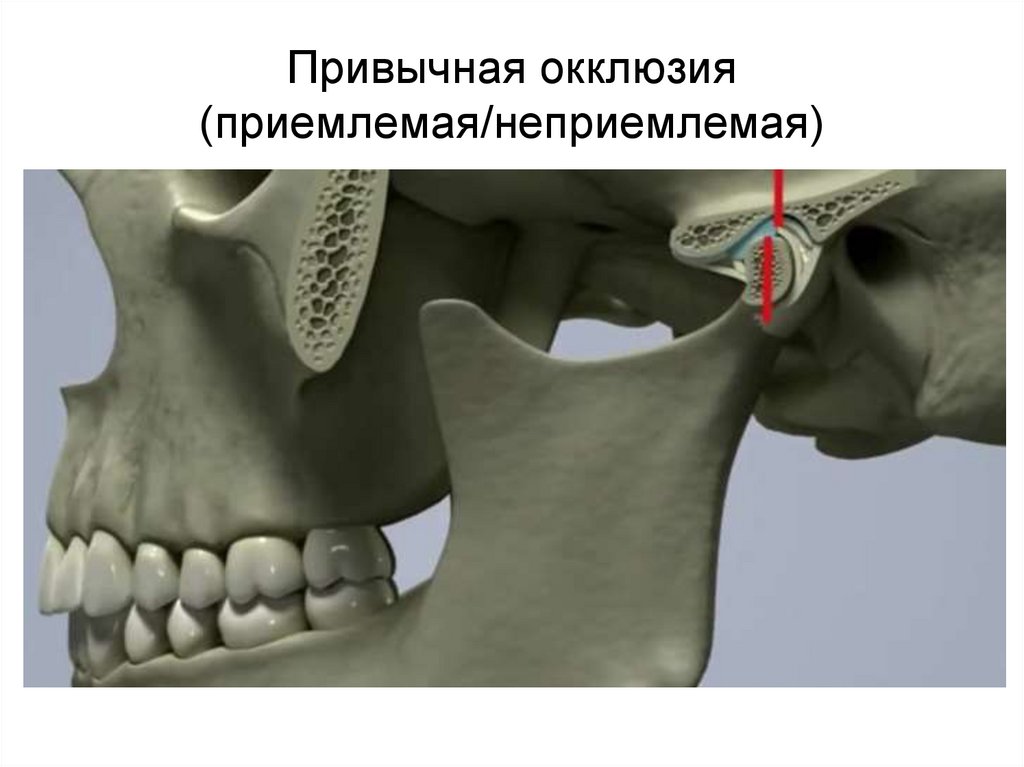 Привычная окклюзия (приемлемая/неприемлемая)