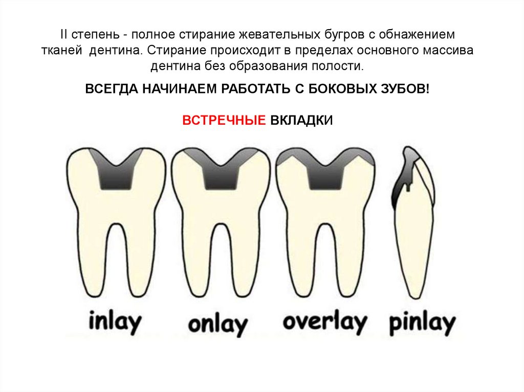 II степень - полное стирание жевательных бугров с обнажением тканей  дентина. Стирание происходит в пределах основного массива