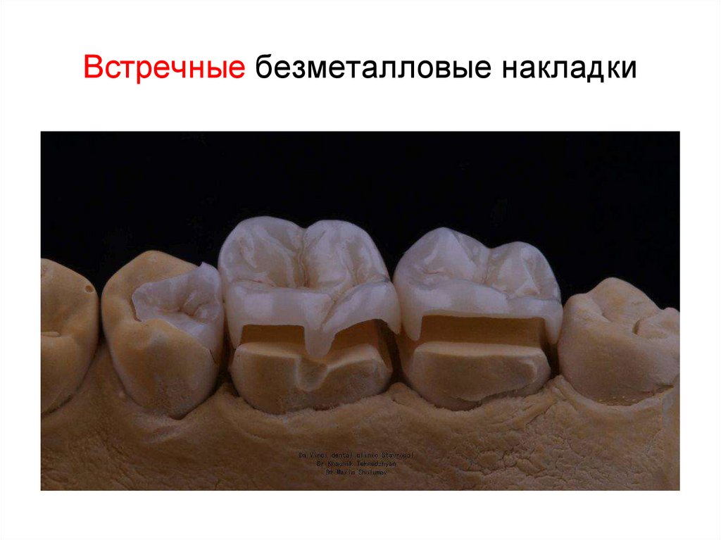 Встречные безметалловые накладки