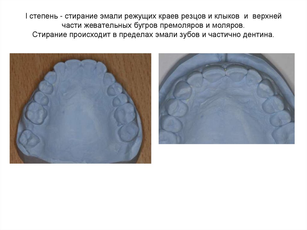 I степень - стирание эмали режущих краев резцов и клыков  и  верхней части жевательных бугров премоляров и моляров. Стирание