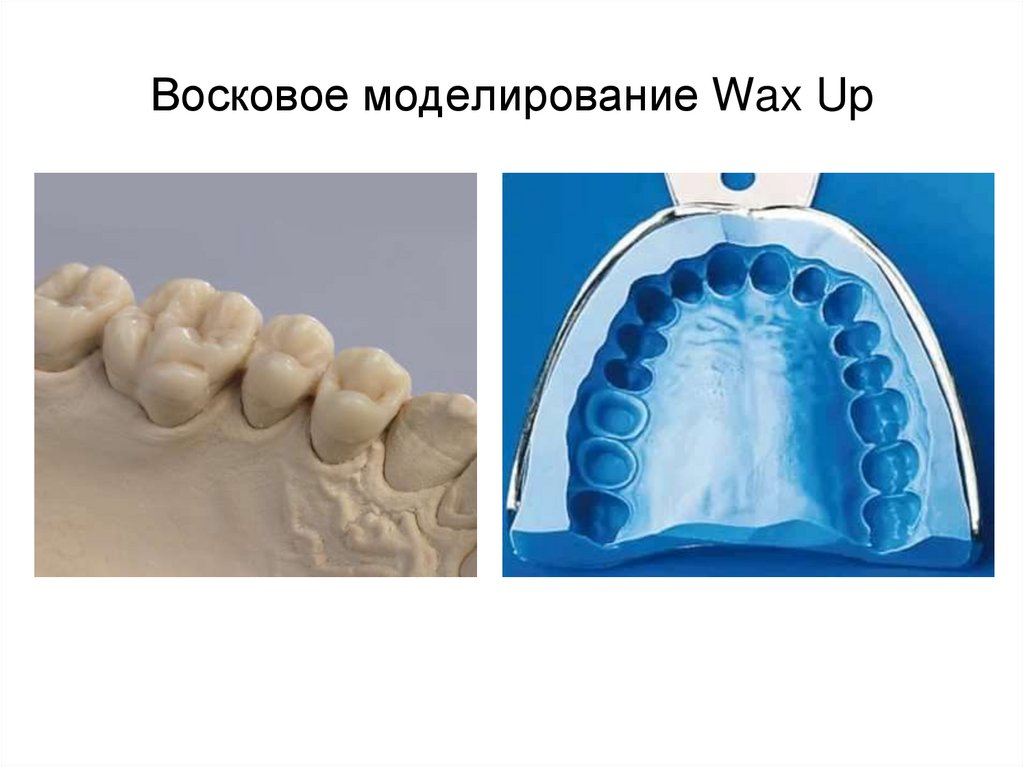 Восковое моделирование Wax Up