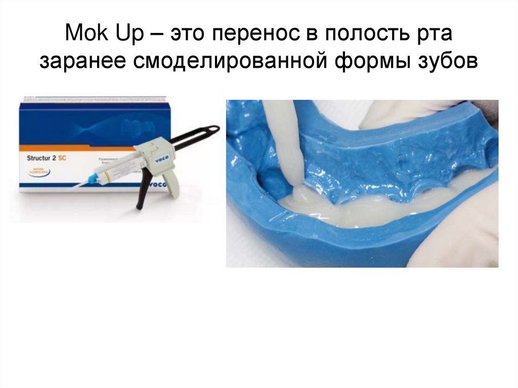 Mok Up – это перенос в полость рта заранее смоделированной формы зубов