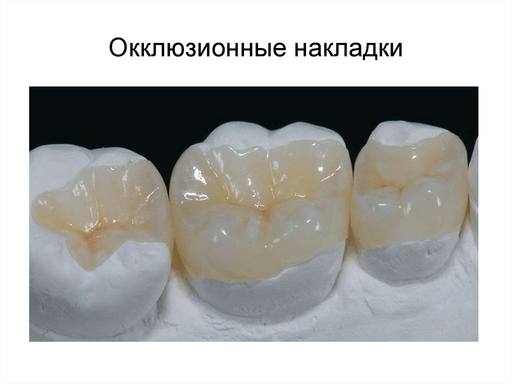 Окклюзионные накладки