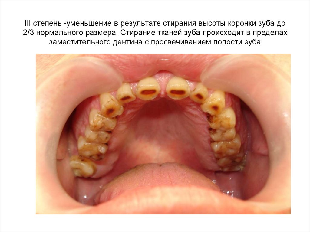III степень -уменьшение в результате стирания высоты коронки зуба до 2/3 нормального размера. Стирание тканей зуба происходит в