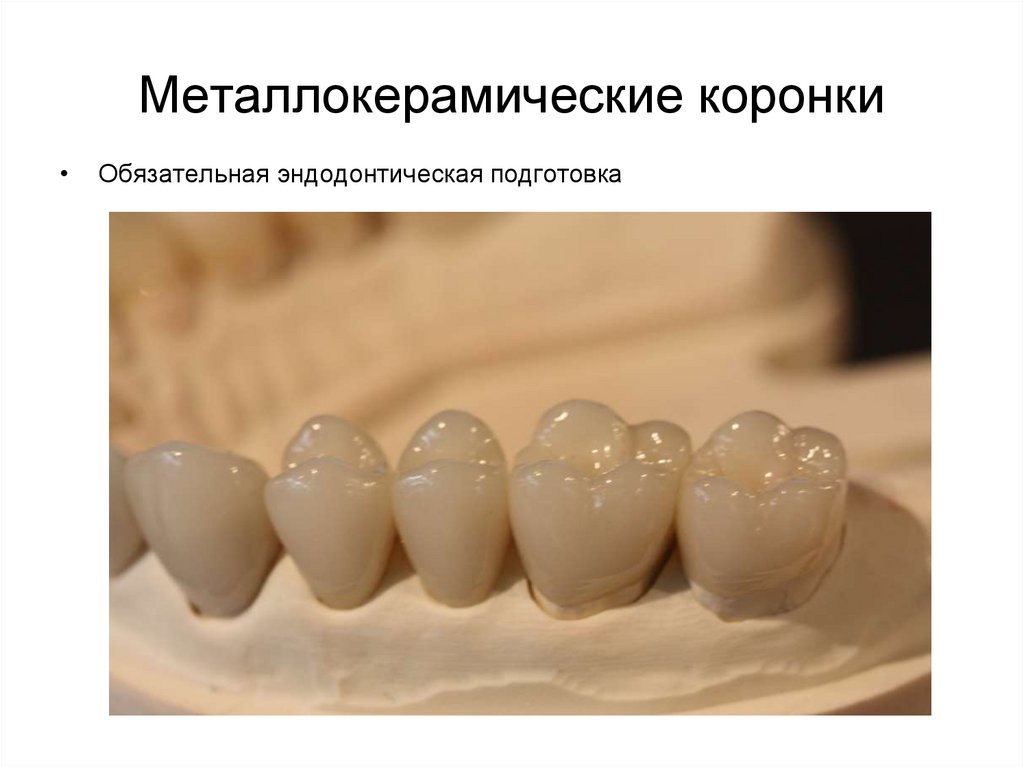 Металлокерамические коронки