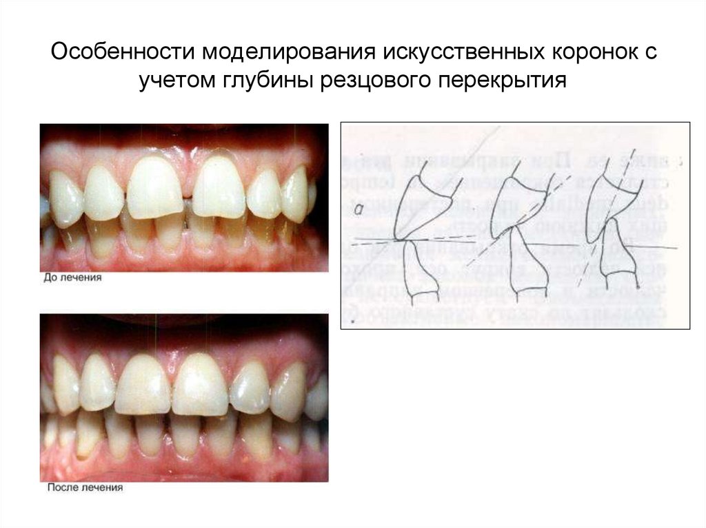 Особенности моделирования искусственных коронок с учетом глубины резцового перекрытия