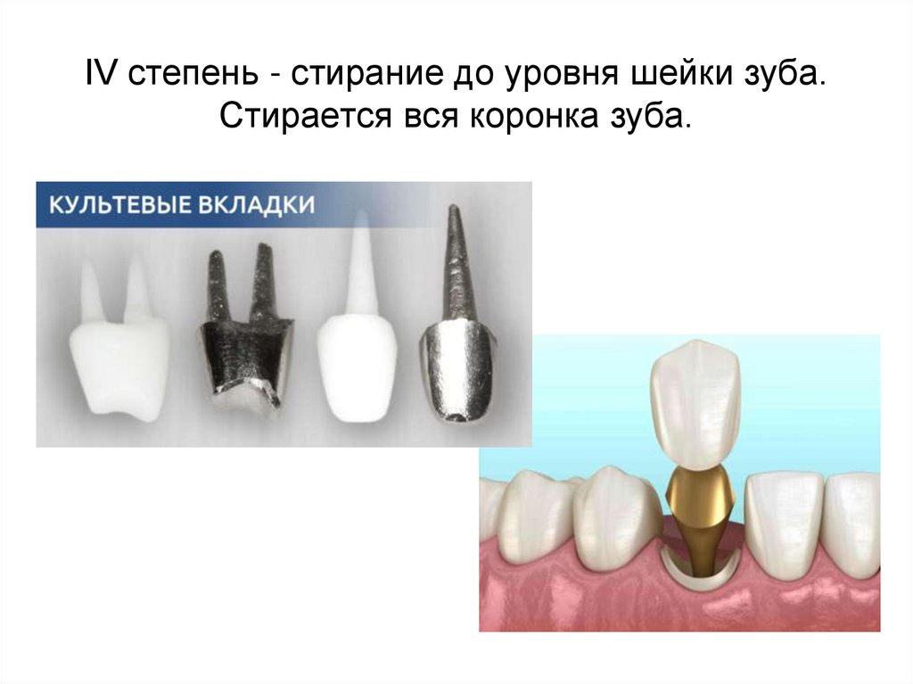 IV степень - стирание до уровня шейки зуба. Стирается вся коронка зуба.