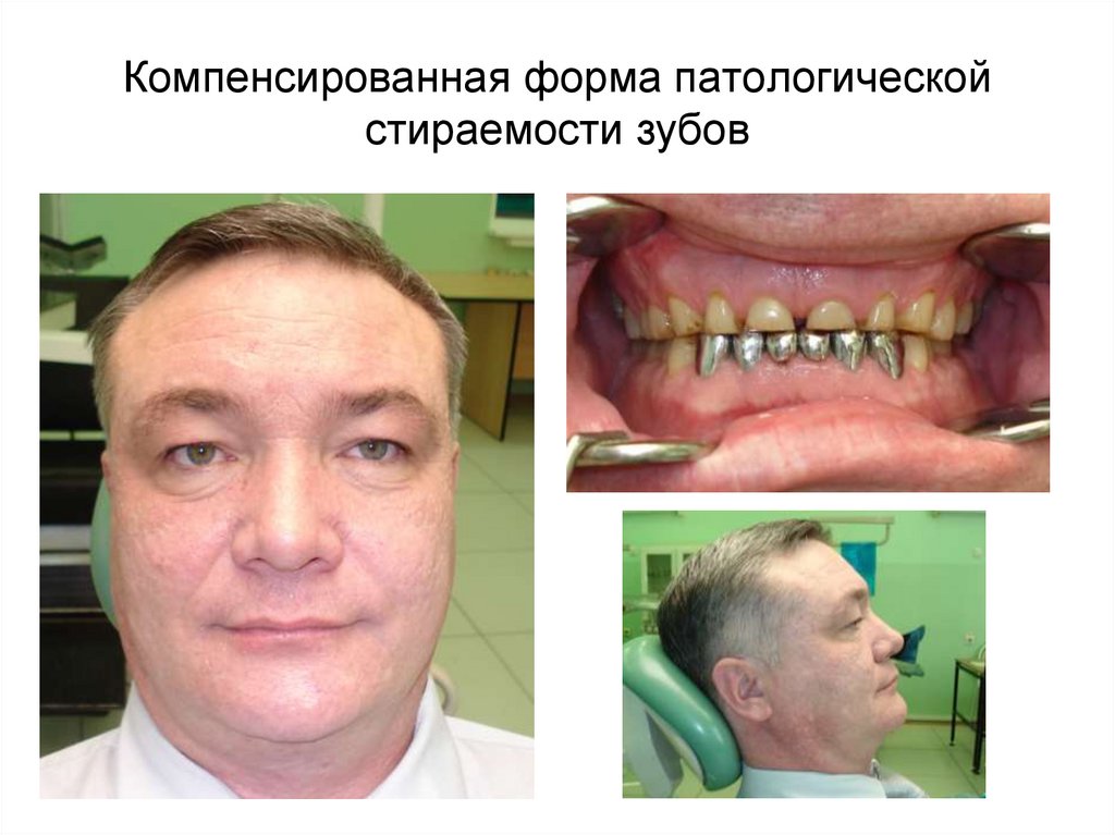 Компенсированная форма патологической стираемости зубов