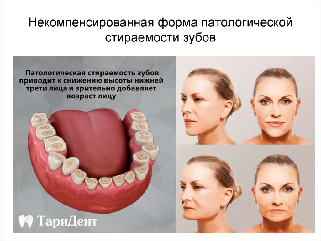 Некомпенсированная форма патологической стираемости зубов