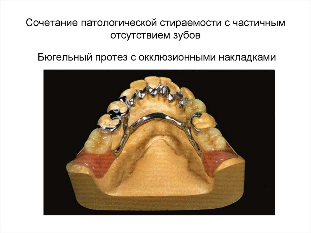 Сочетание патологической стираемости с частичным отсутствием зубов